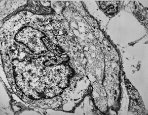 M,15y. | rhabdomyoma - lip